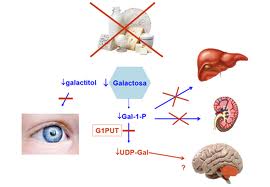 oqueegalactosemia4